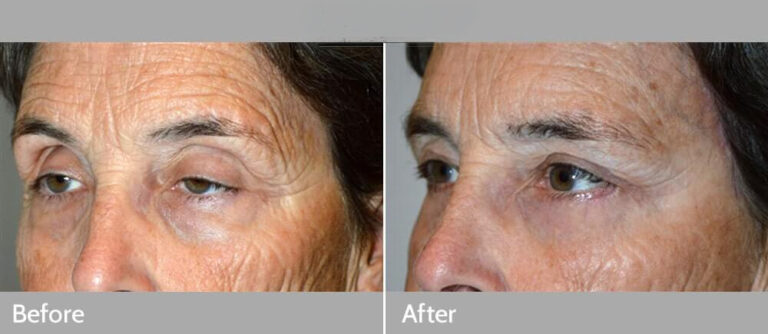 Droopy-Eyelid-Surgery-Treatment-1-1_edited