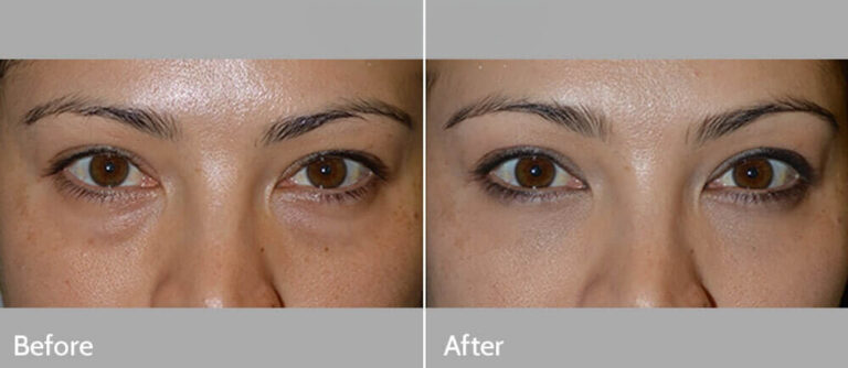 Lower-Eyelid-Treatments-Before-After-1-1_edited